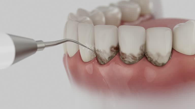 Trusted Wisdom Tooth Removal service in San Jacinto, CA - Dentist Open Now